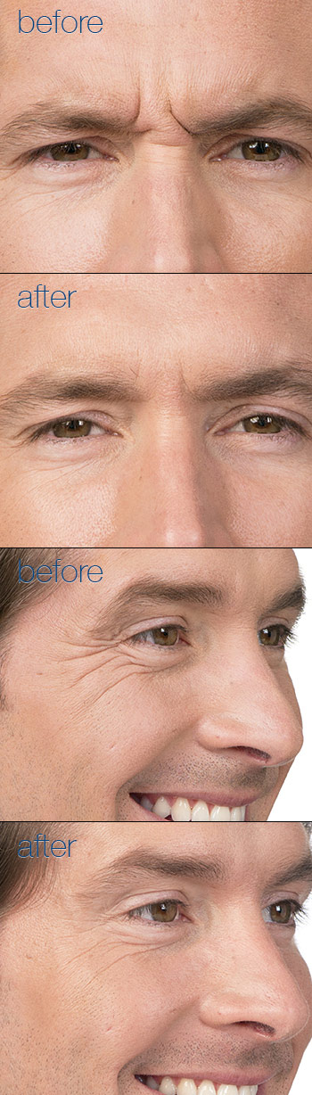 Botox Dermal Fillers